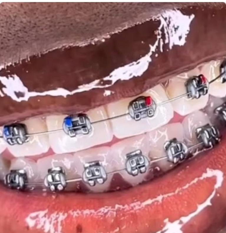 Removable Silver Braces - Stylish and affordable
